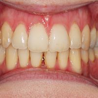 Teeth Whitening before